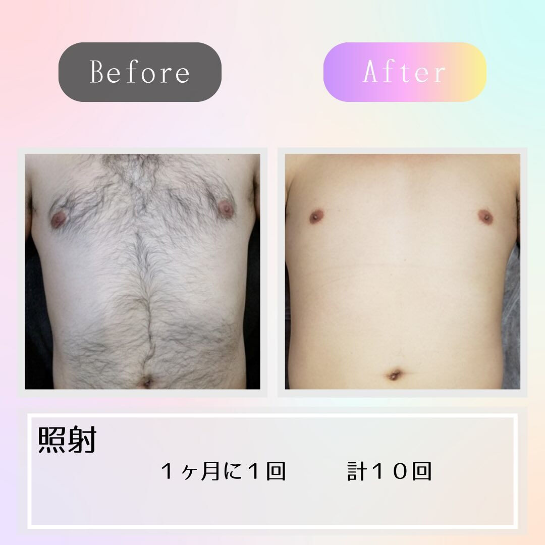 光脱毛で胸毛と腹毛がツルツルに！