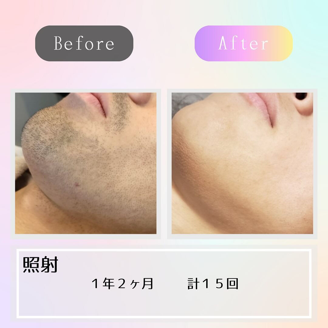 あご髭が15回施術でツルツルに！？