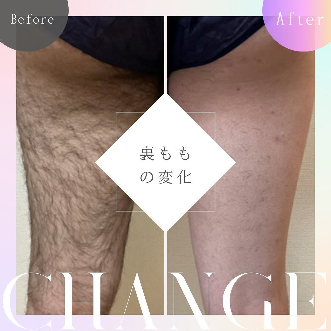 男の剛毛からツルスベ肌へ