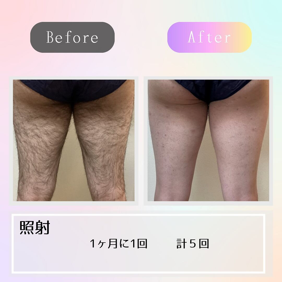 男の剛毛からツルスベ肌へ