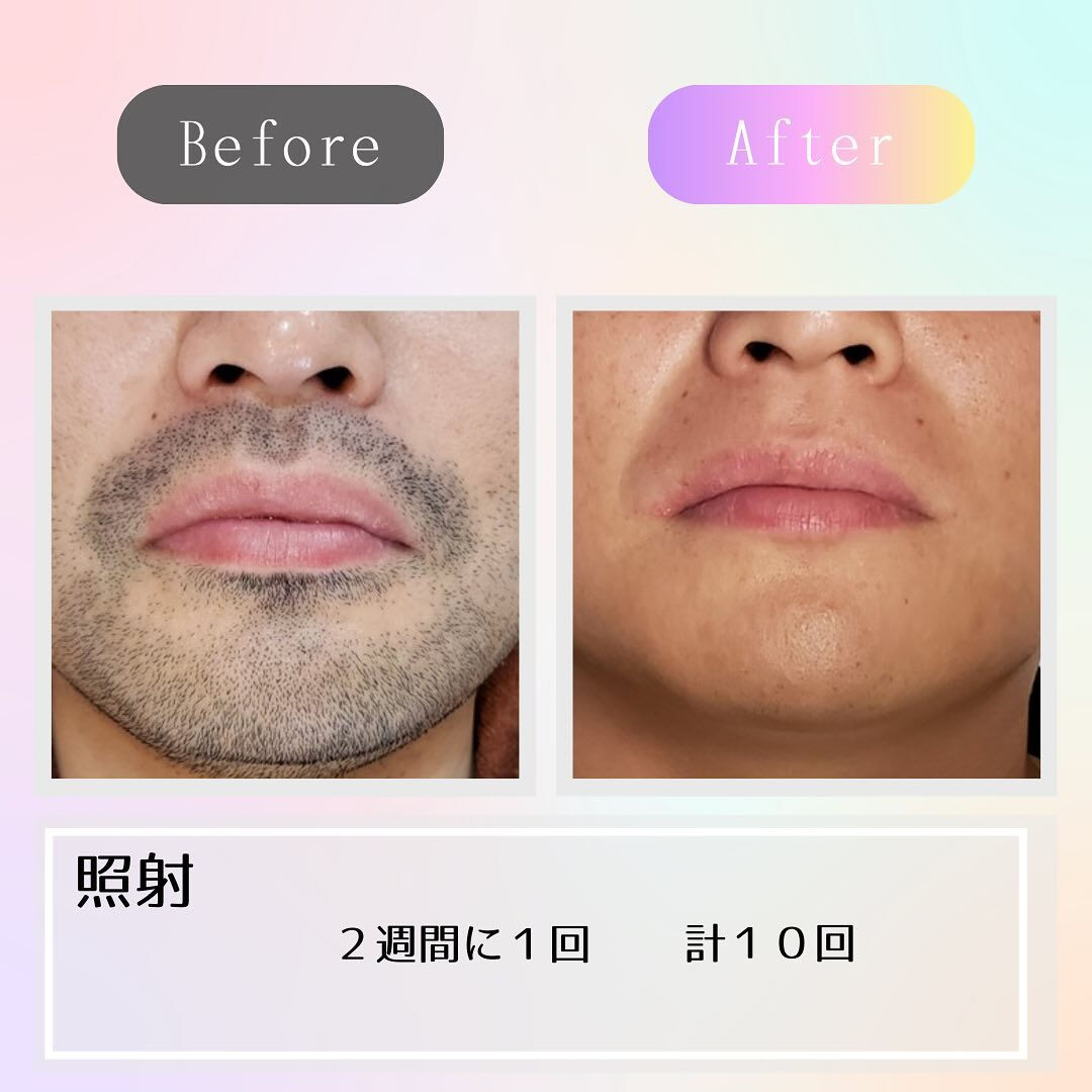 光脱毛で青髭からの脱却