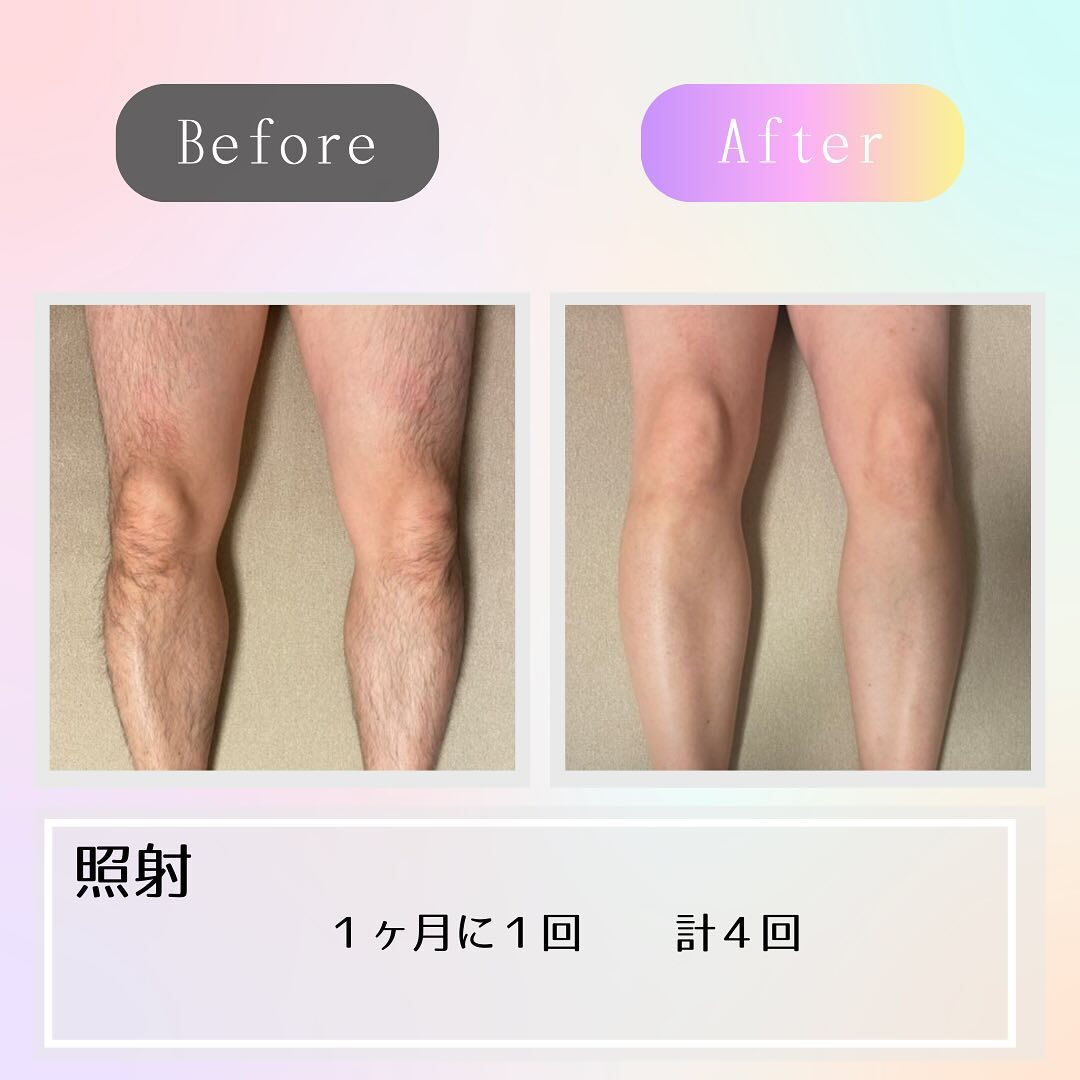 足毛の脱毛で好印象に！