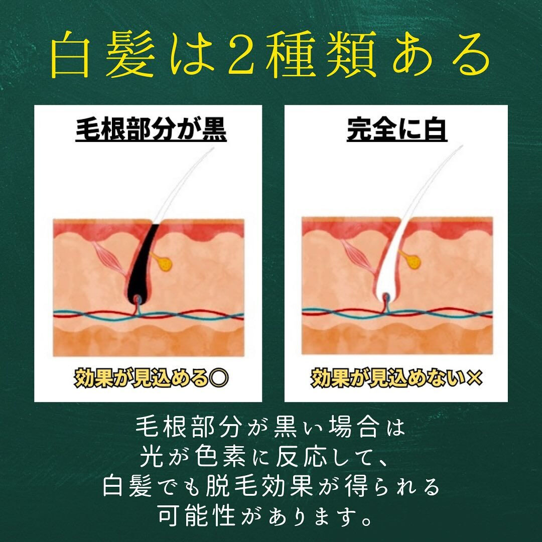 白髪に脱毛効果はあるの？