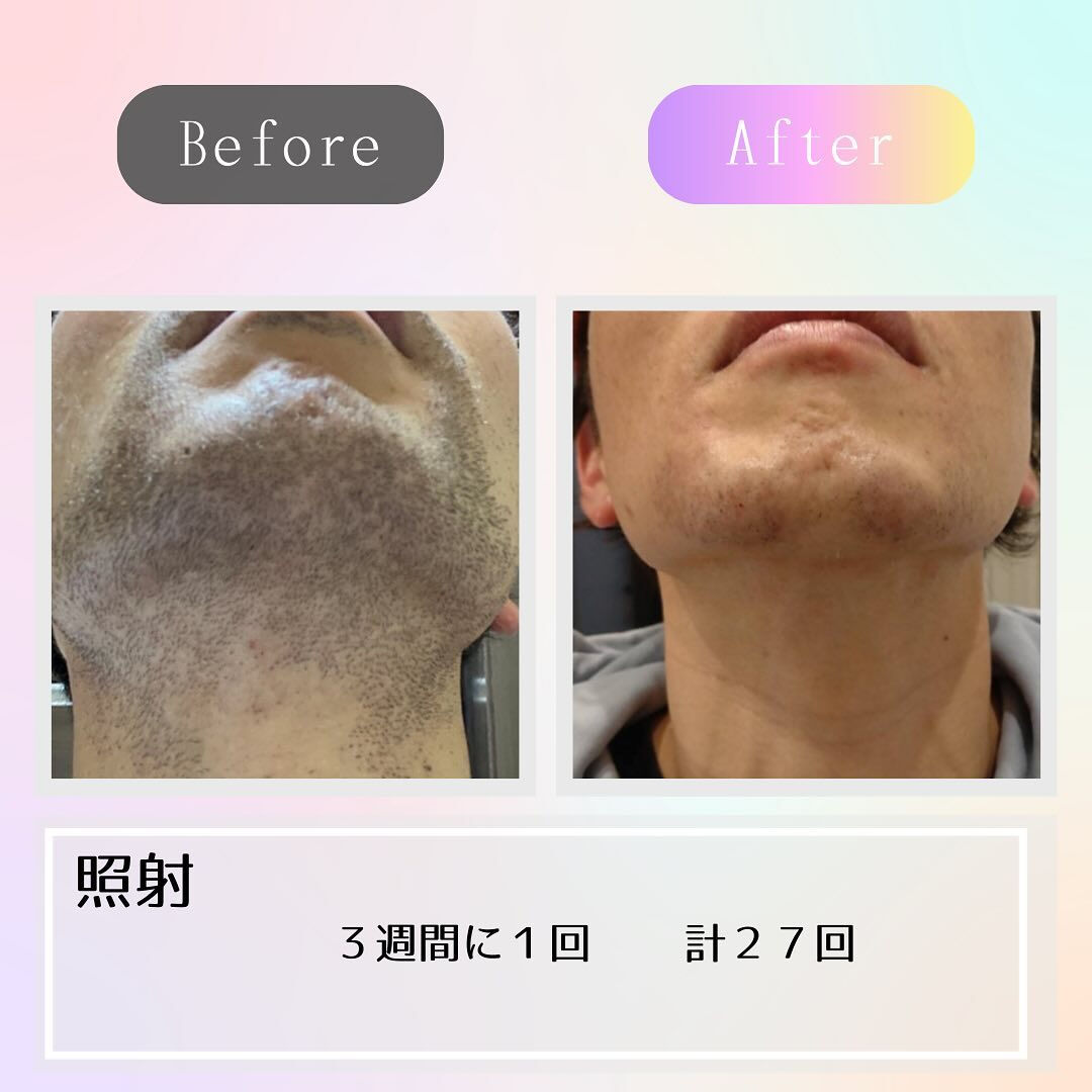 印象が変わるあご髭