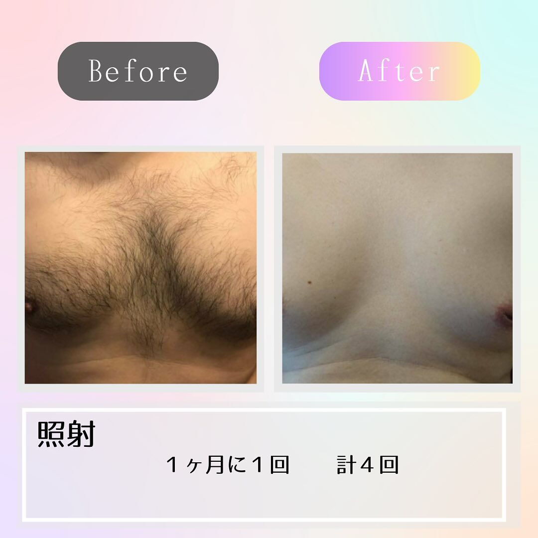 胸毛のビフォーアフター
