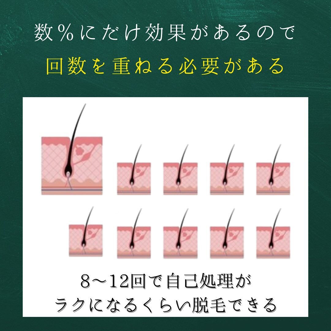 光脱毛は通う回数と間隔が大切！