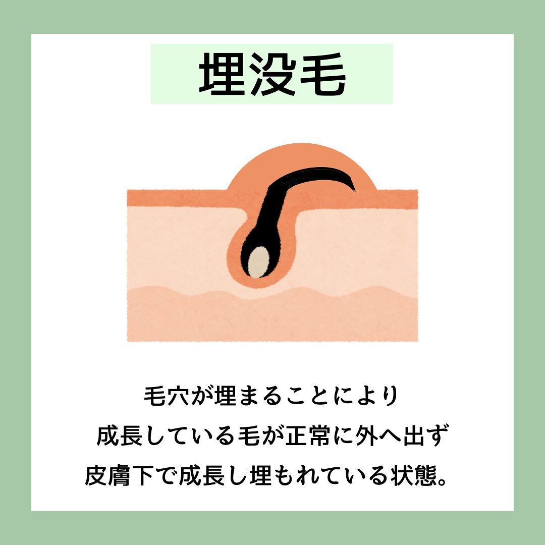 埋没毛の予防方法4選